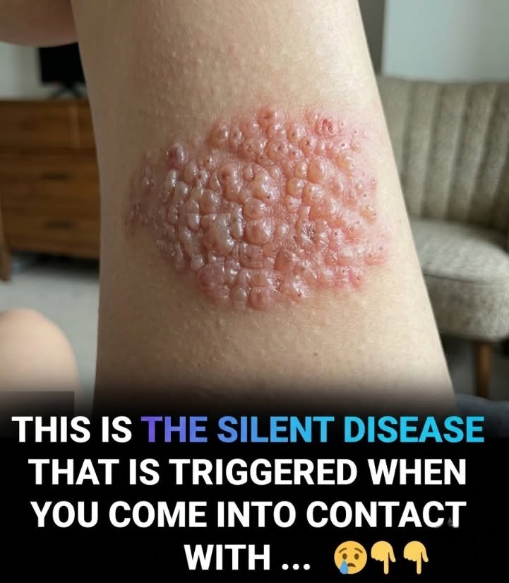 Early Warning Signs of Shingles and Why Prompt Treatment Matters
