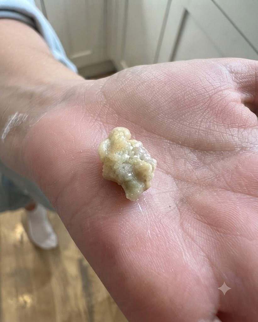 Here’s What You Need to Know About Tonsil Stones and Why They’re Getting So Much Attention